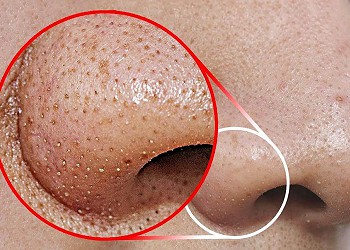 THE BLACKHEAD BUSTER FACIAL!