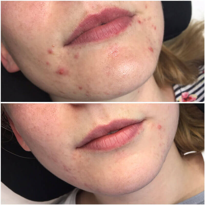 Dermalux before after