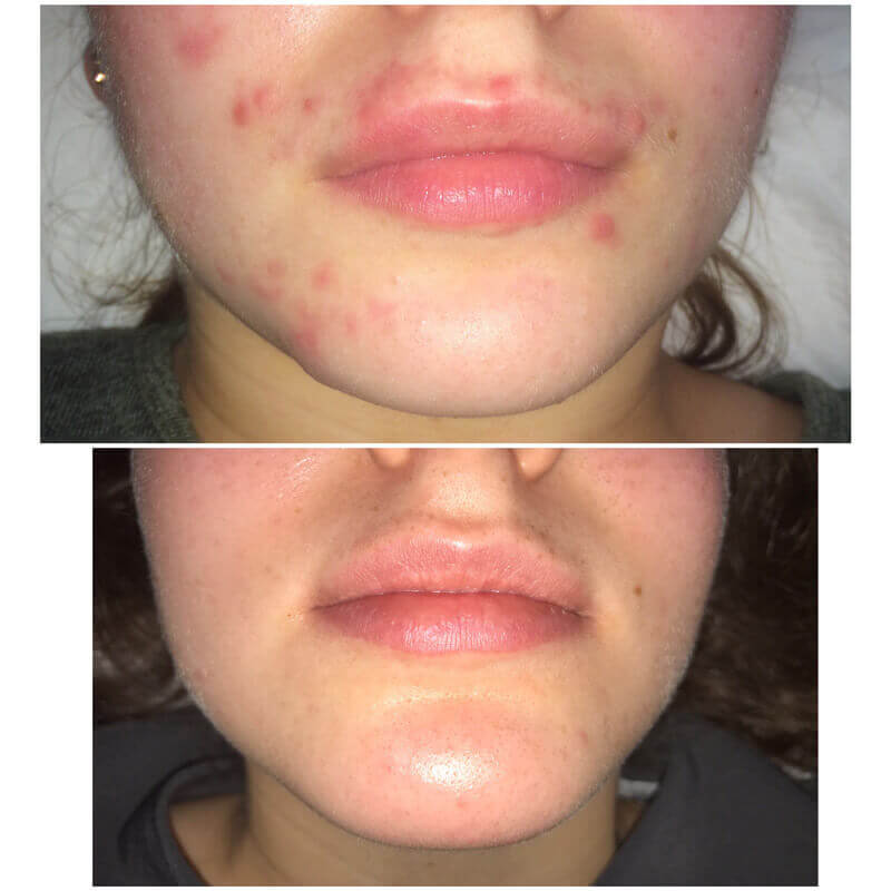 Dermalux before after