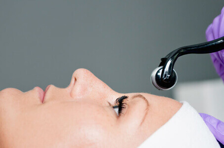 Microneedling Treatments